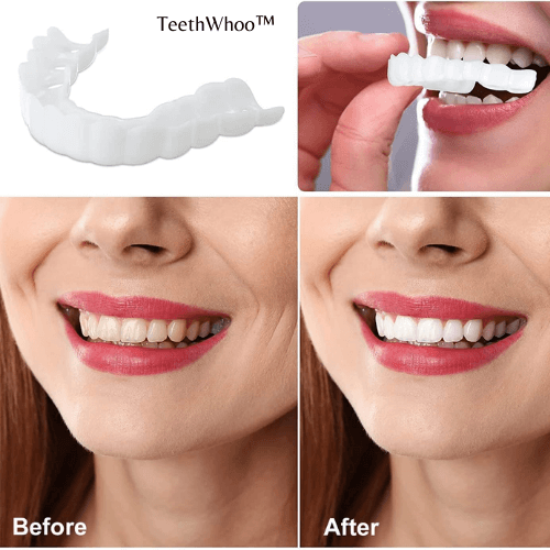 TeethWhoo™ Snap-On Dentures | 58% OFF LAST DAY - Coolpho