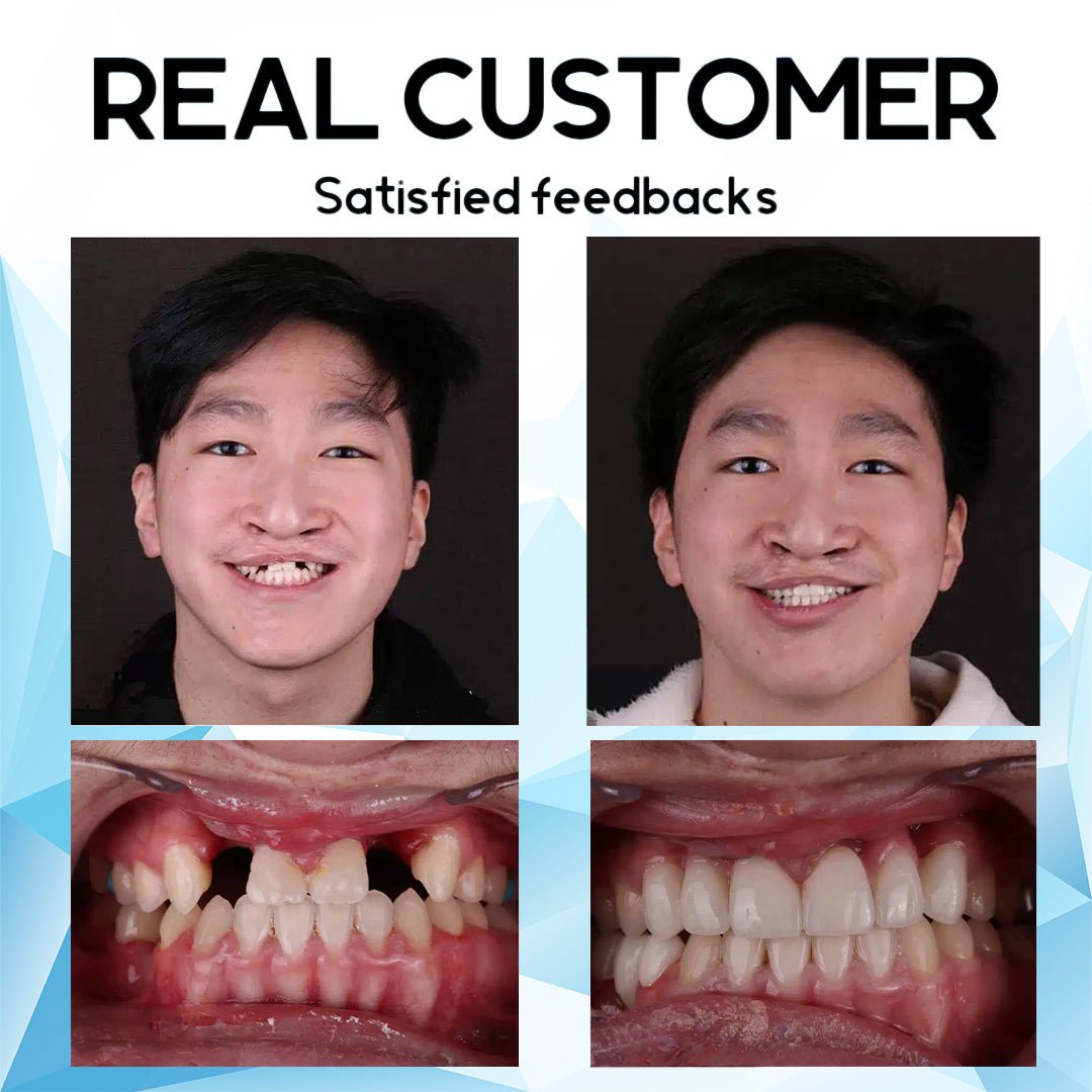 SmileRevive Pro – Transform Your Smile with Our Silicone Reline Denture Set - VERRANOO